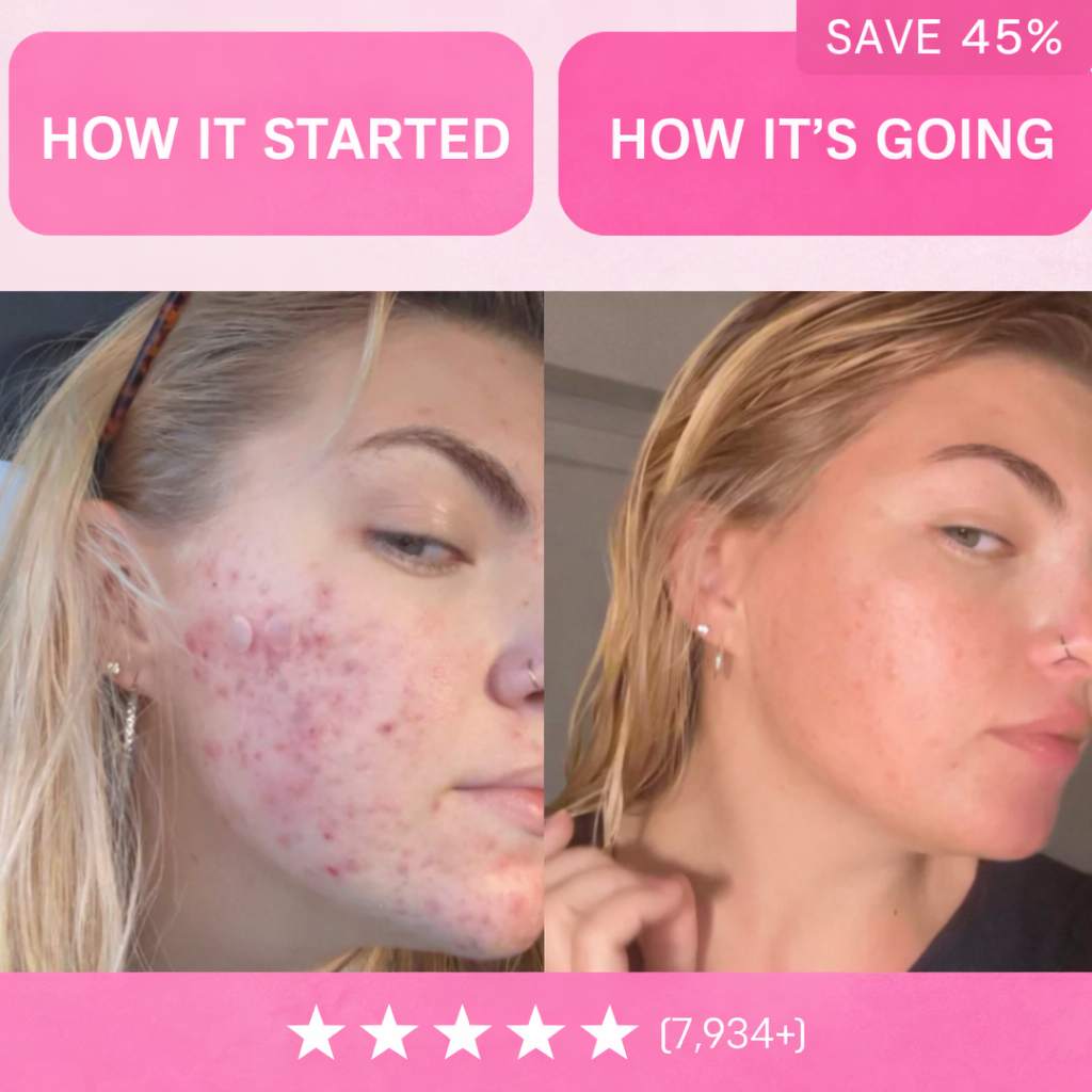 Nuvé™ Acne & Redness Reset Ritual